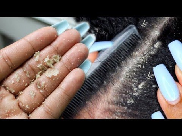 Lice eggs vs Dandruff