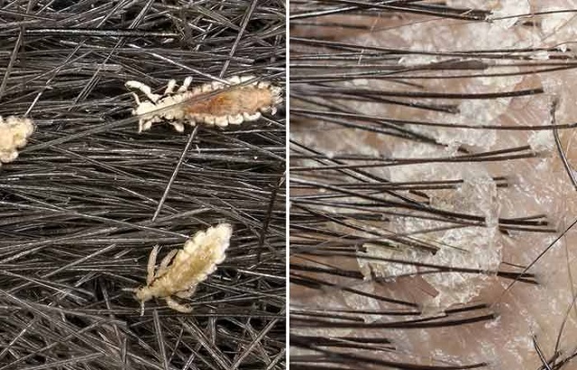 Lice eggs vs Dandruff