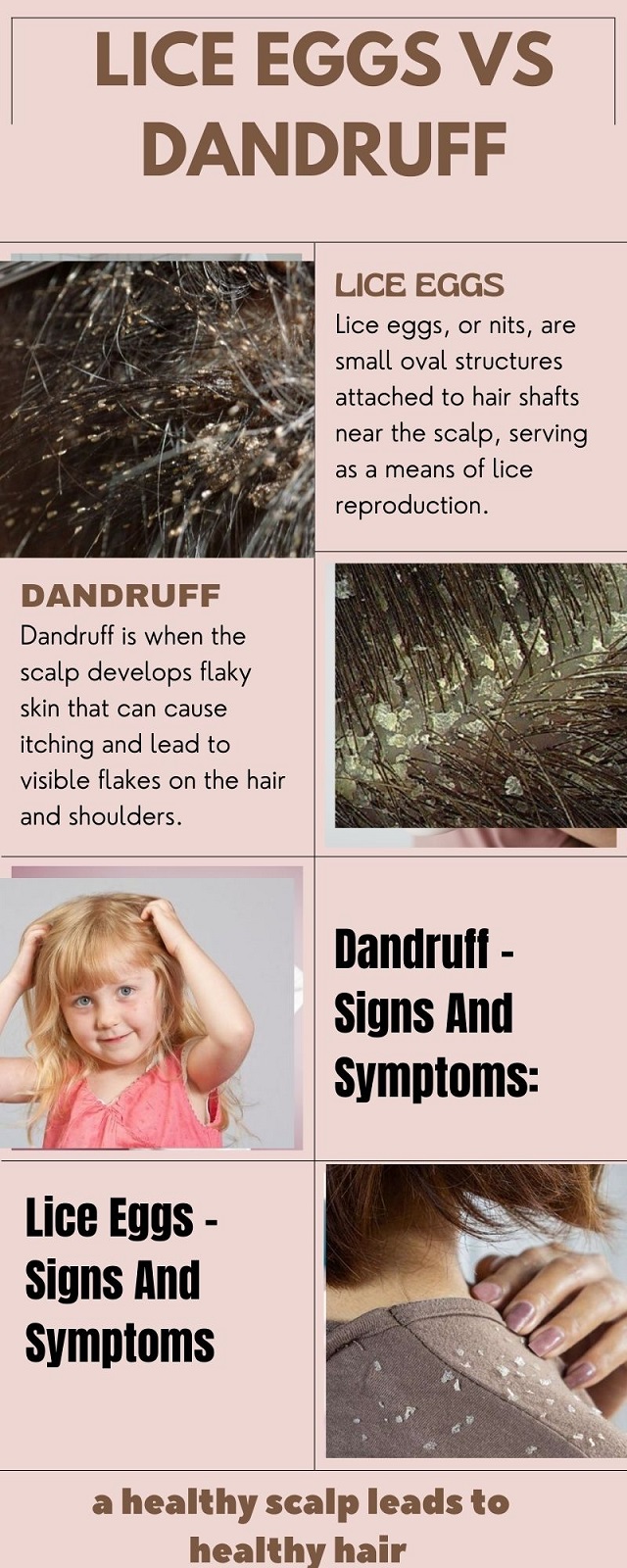 head lice eggs vs dandruff
